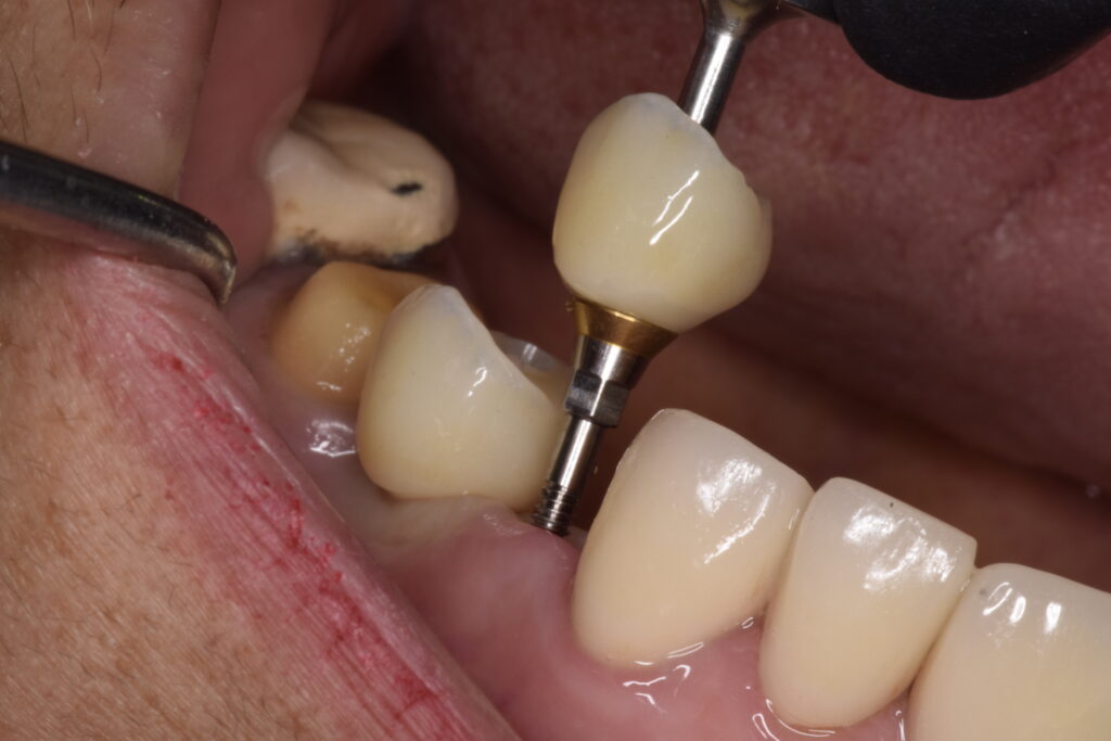 Root Canal in Tijuana